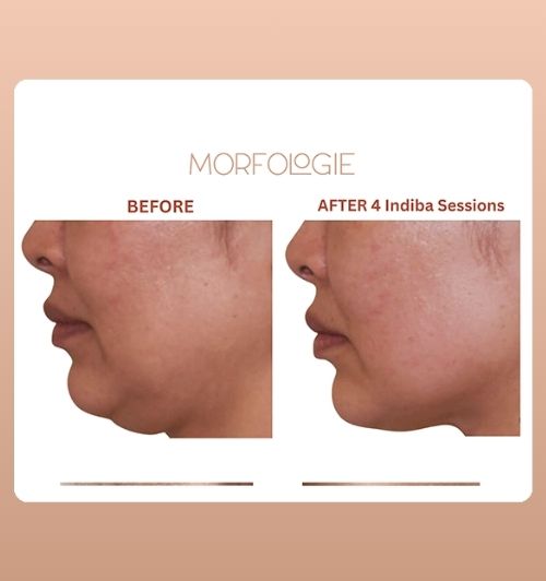 morfologie before after image (12)