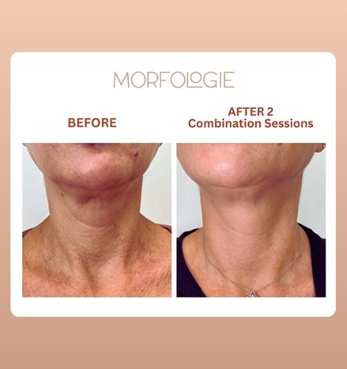 morfologie before after image (25)