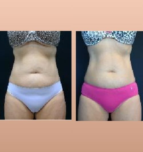 morfologie before after image (5)