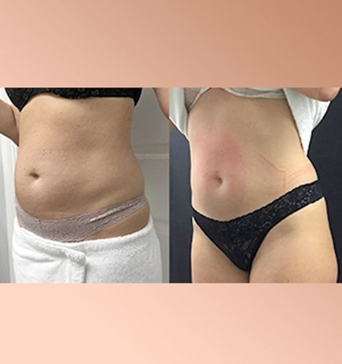 morfologie before after image